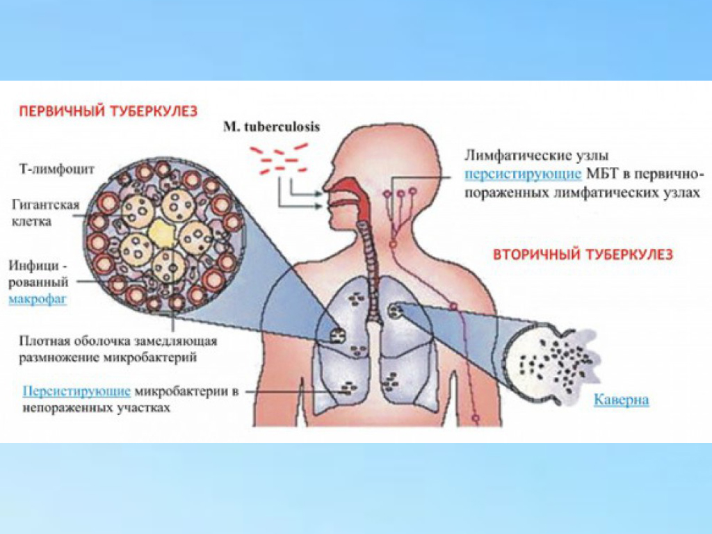 Первичный и гематогенный туберкулез.