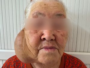 Опухоль росла 10 лет: хирурги успешно удалили гигантское новообразование подчелюстной области